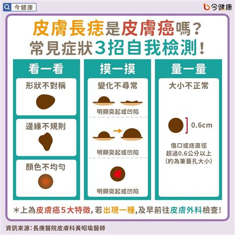 腹部長痣|皮膚長痣是皮膚癌嗎？常見症狀，簡單3招自我檢測｜ 